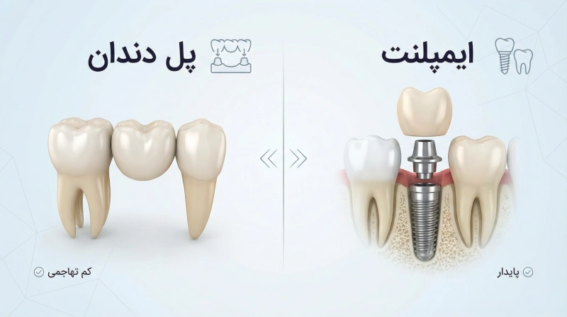 هل جسر الأسنان أم زراعة الأسنان أفضل؟ مقارنة لقرار أفضل