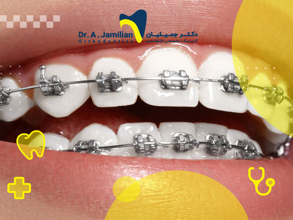 Methods of cleaning and maintenance of fixed orthodontic plate - Dr. Jamilian