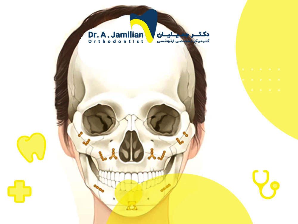 How to prevent dangerous complications in jaw surgery? - Dr. Jamilian
