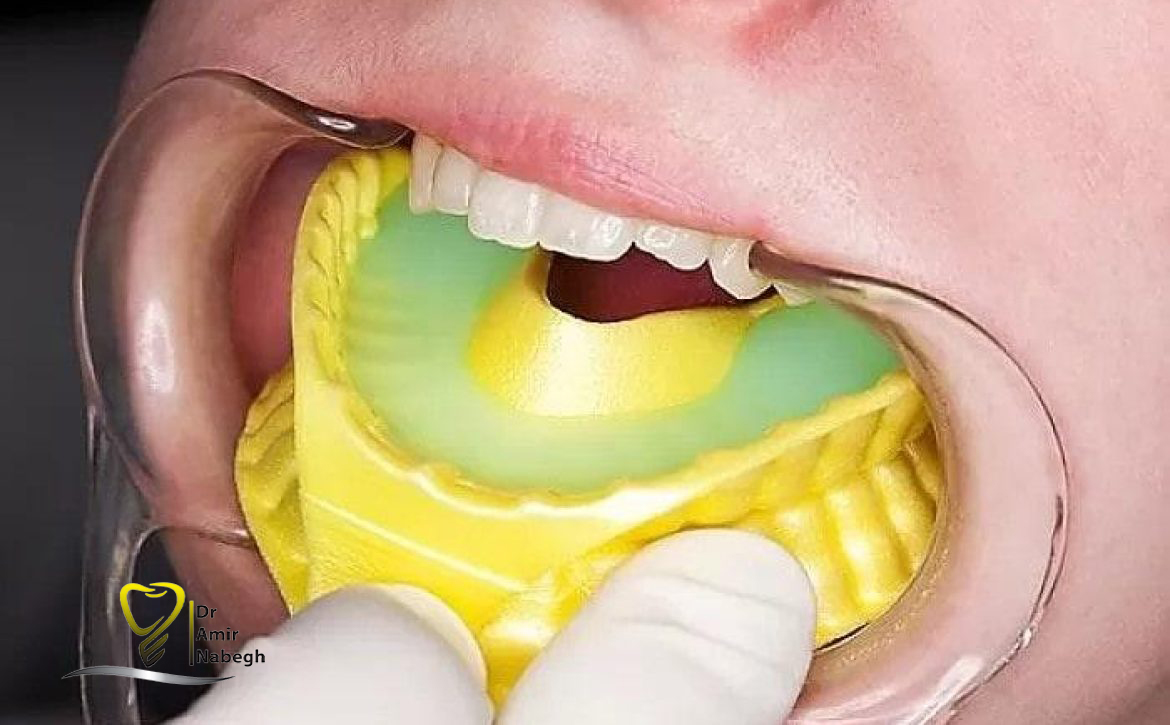 فلوراید تراپی