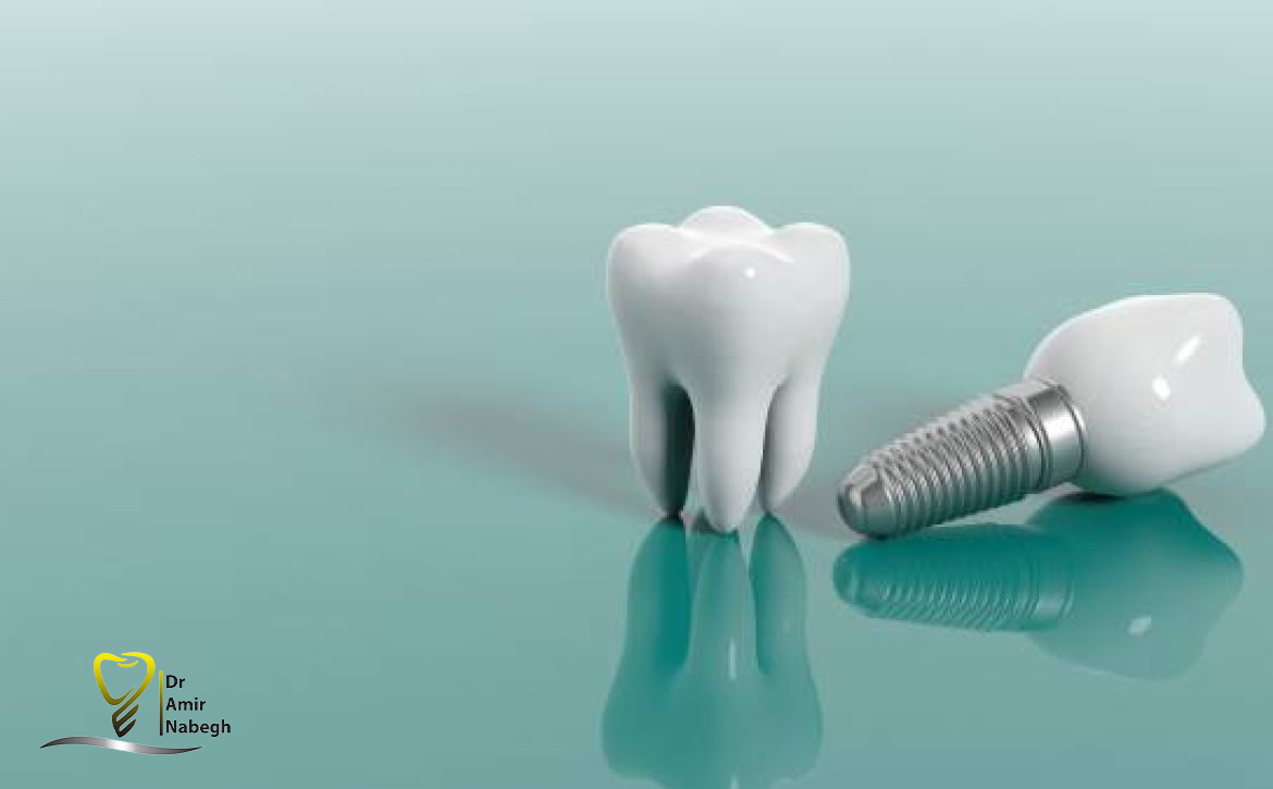 بهداشت دهان و دندان برای ایمپلنت