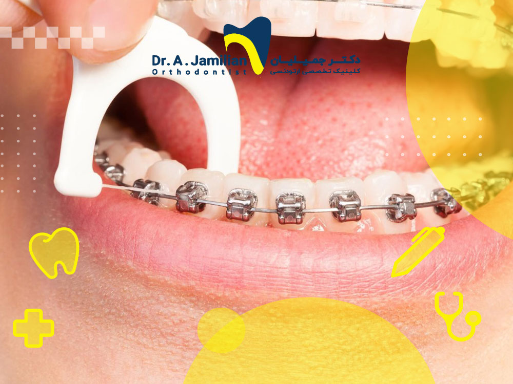 Why is orthodontic floss necessary? - Dr. Jamilian