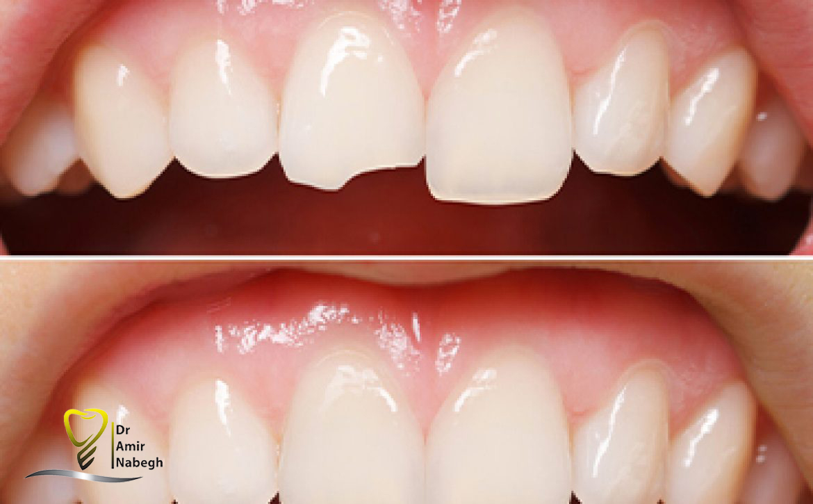 روکش سرامیکی