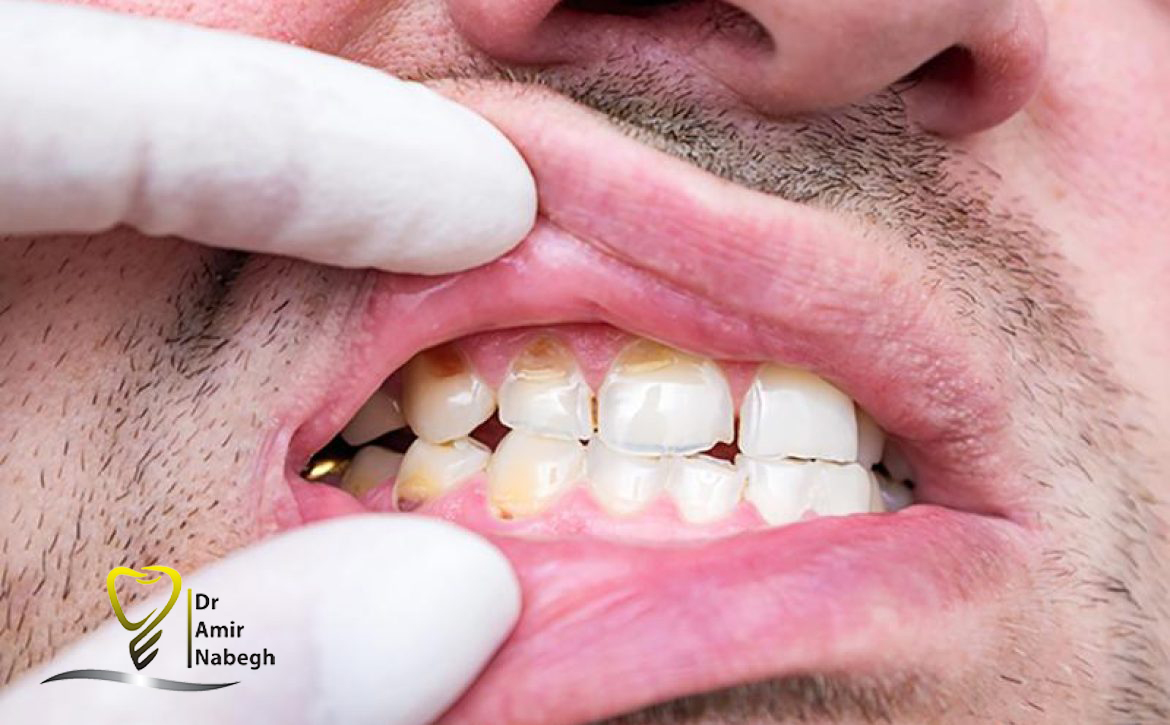 راه های مراقبت از مینای دندان