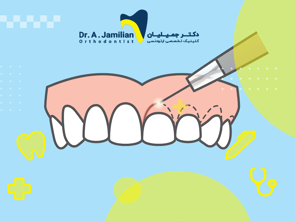 Gum surgery, types of methods and purpose of treatment - Dr. Jamilian