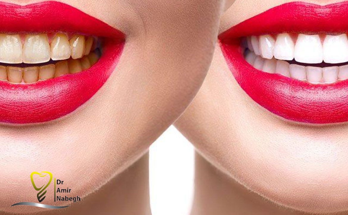 بلیچینگ دندان