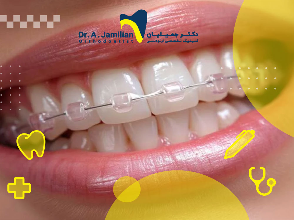 Ceramic orthodontics, all you need to know - Dr. Jamilian