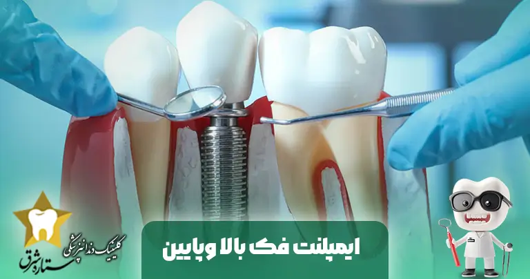 الاختلافات بين زراعة الأسنان في الفك العلوي والسفلي