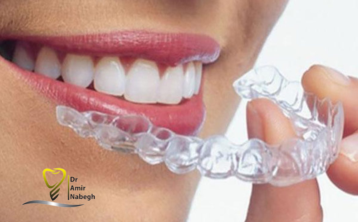 نایت گارد یا محافظ دهان چیست؟