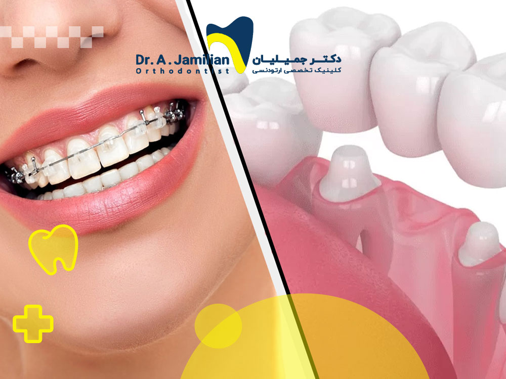 Does bonded veneer help orthodontic treatment? - Dr. Jamilian