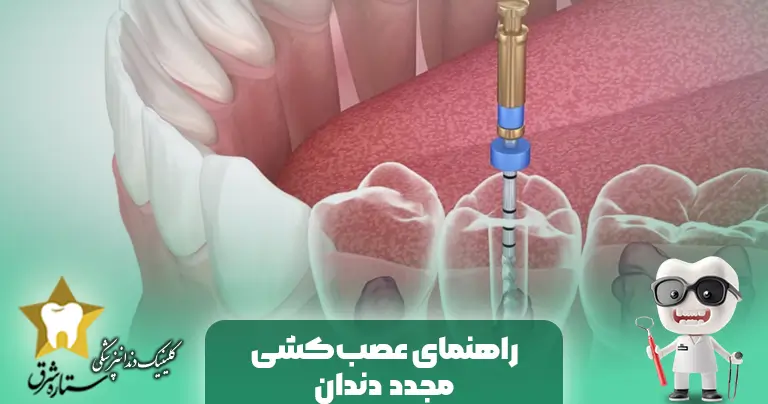 الدليل الكامل لإعادة أعصاب الأسنان (Re-endo)