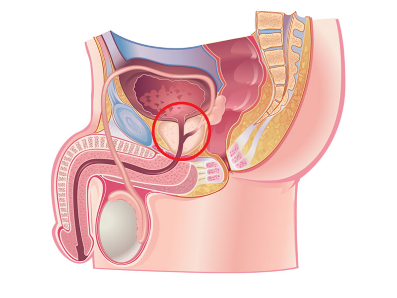 ما هي جراحة البروستاتا وتطبيقاتها وأنواعها المختلفة؟