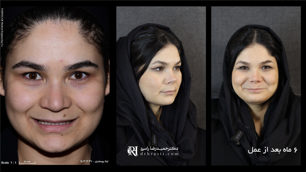 ما هي نسبة عمليات تجميل الأنف التي تؤثر على الجمال؟ - د. حميد رضا راستي