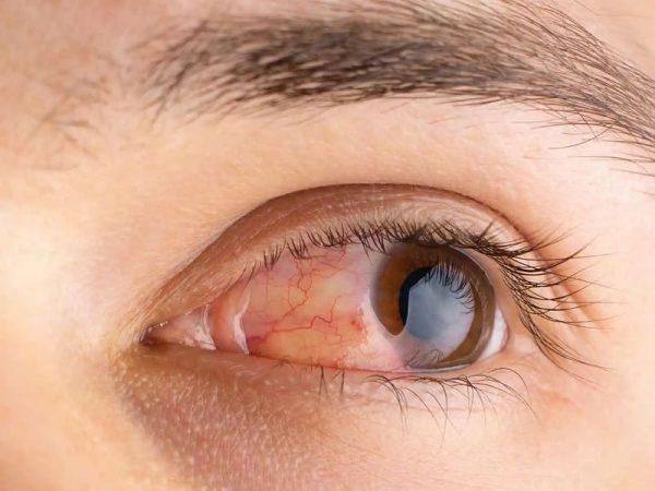 ما هي الحلول المفيدة لعلاج حساسية العين وحساسية العين؟ - د. أحمد رضا خليليان