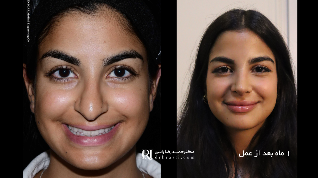 تدلي طرف الأنف: دليل كامل للجراحة والعلاجات غير الجراحية - د. حميد رضا راستي