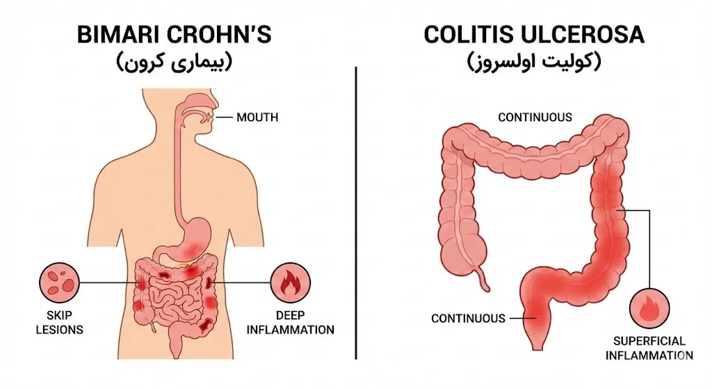 The difference between Crohn's and ulcerative colitis; Why is the diagnosis, symptoms and treatment of each one suitable in simple language? - Inflammatory bowel diseases clinic