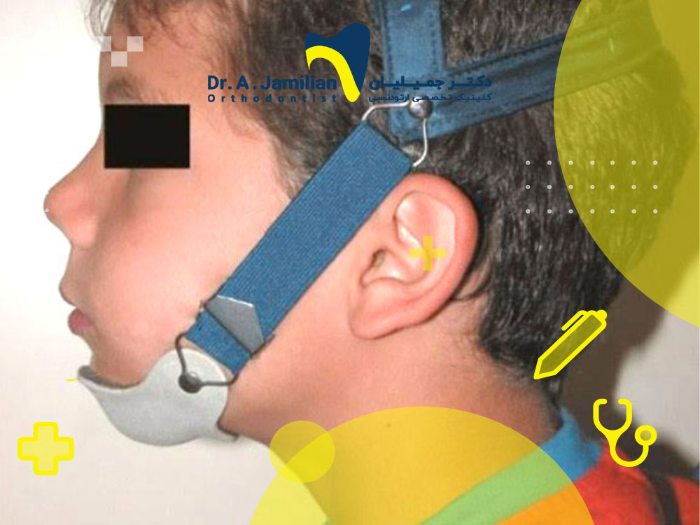 حزام الذقن التقويمي أو الطبي + أنواعه ووظيفته وحدوده - د. جميليان