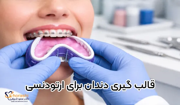 ما هو صب تقويم الأسنان؟ | كم من الوقت يستغرق وكم يضر؟