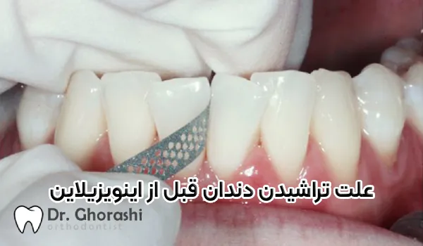 ما هو سبب حلق الأسنان قبل الإينفيزلاين؟