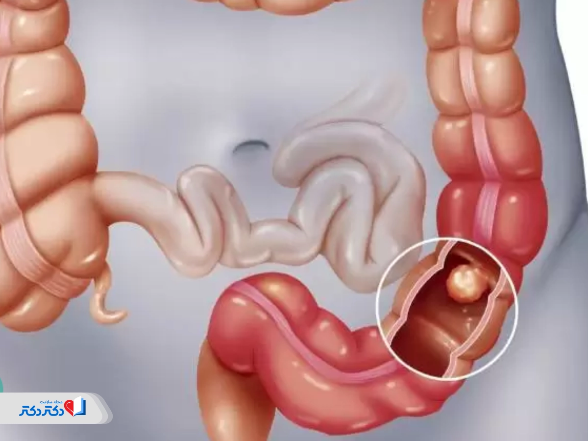 أعراض انسداد الأمعاء مؤشرات عند البالغين والأطفال والرضع