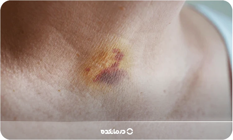 bruised neck; Causes, side effects + 5 gels and ointments to remove bruises immediately